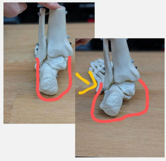 過剰回内の足の骨の模型.png
