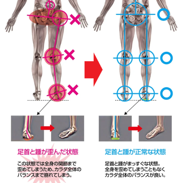 骨格矯正を促すインソール3.png